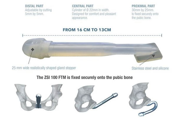 ZSI 100 FTM Malleable Penile Implant